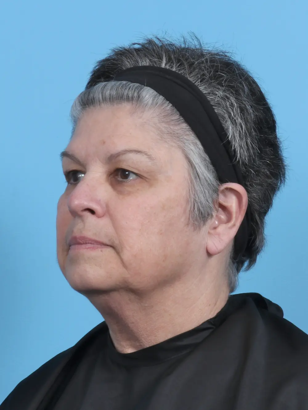 Eyelid Surgery Patient Photo - Case 50512 - before view-1