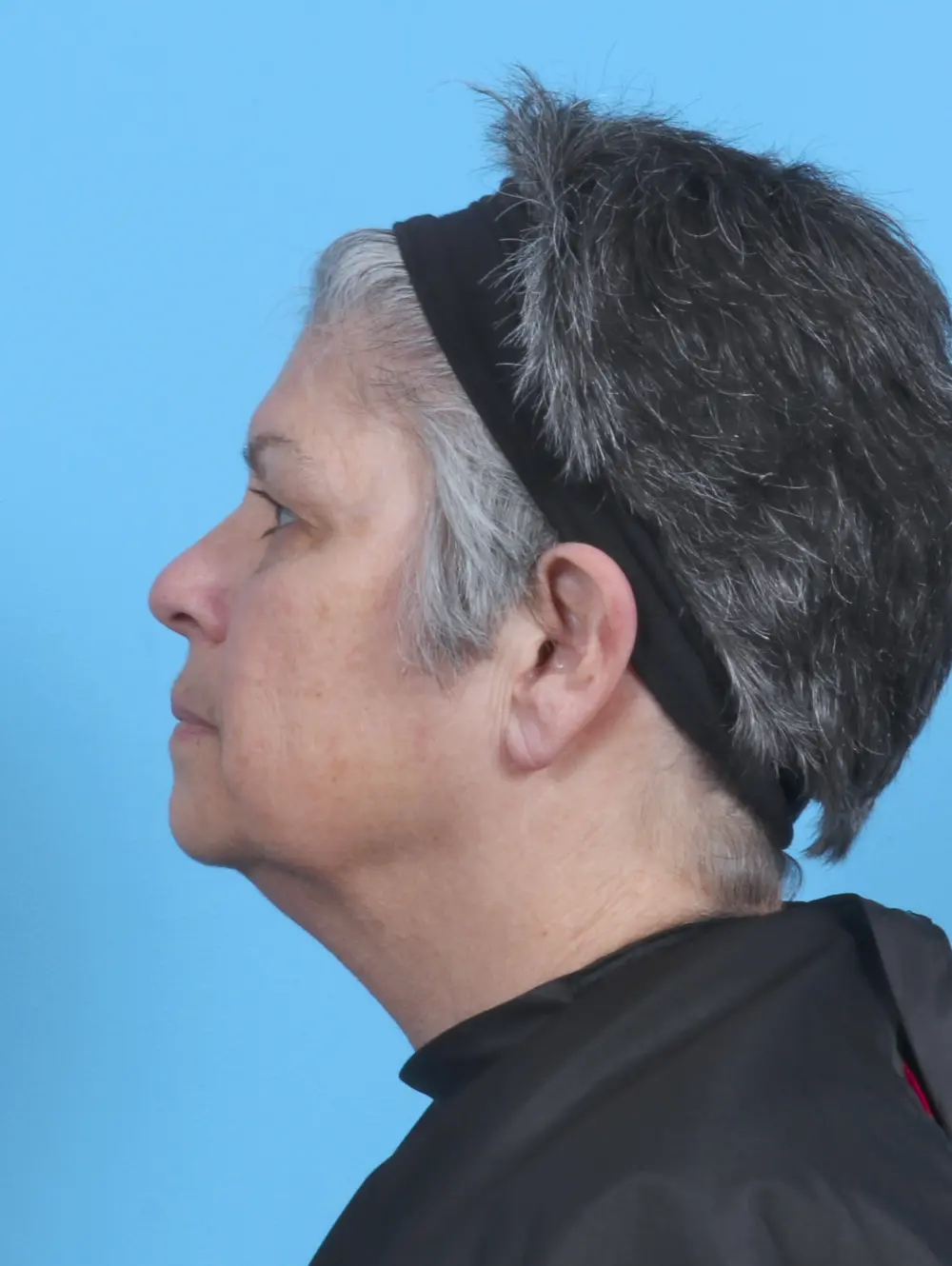 Eyelid Surgery Patient Photo - Case 50512 - before view-2
