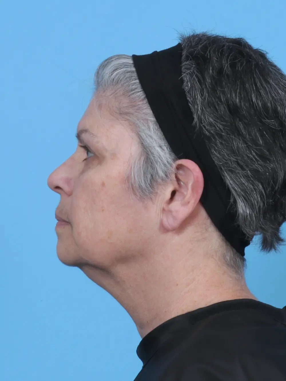 Eyelid Surgery Patient Photo - Case 50512 - after view-2