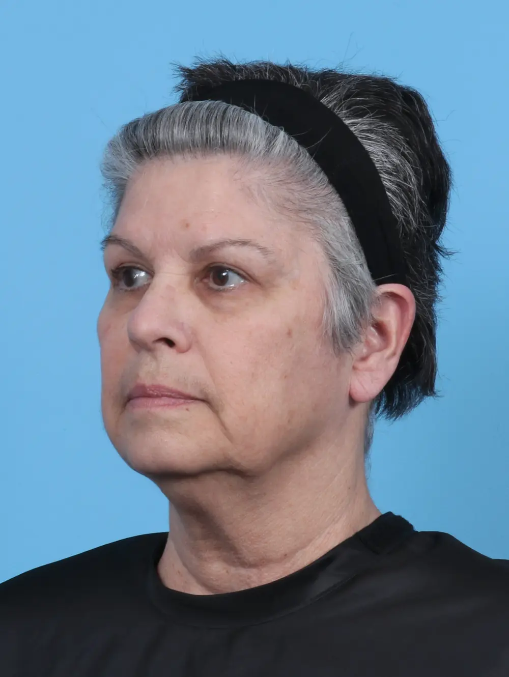 Eyelid Surgery Patient Photo - Case 50512 - after view-1