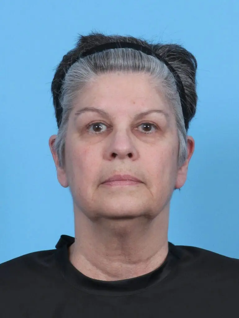 Eyelid Surgery - Case 50512 - After