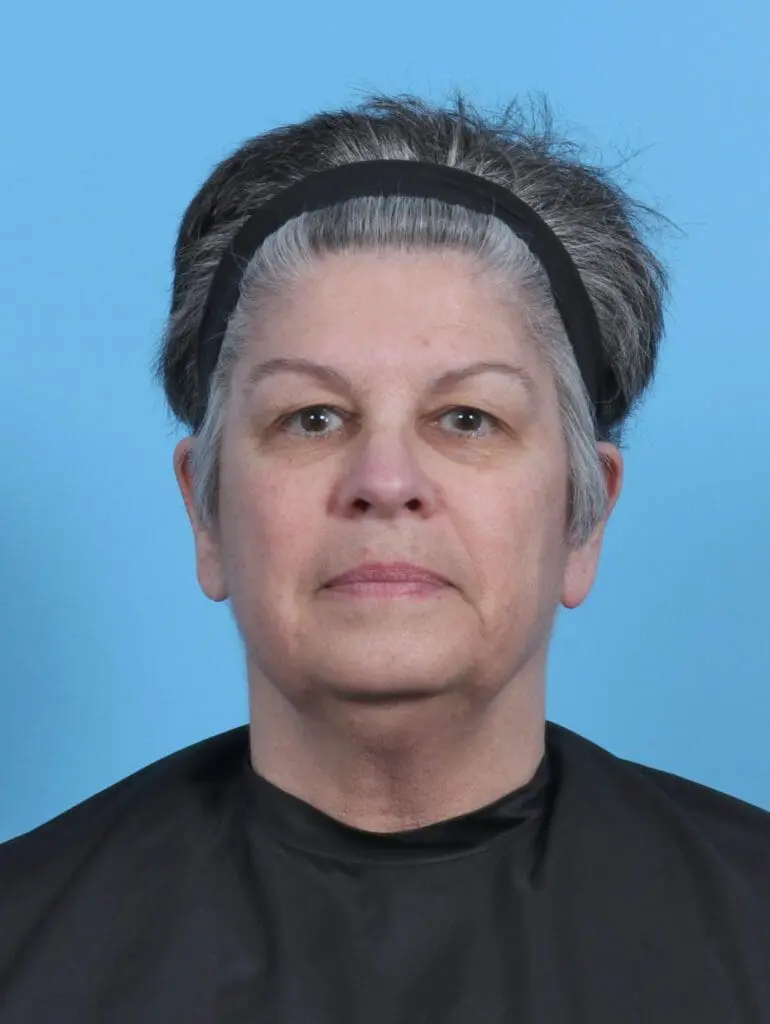 Eyelid Surgery - Case 50512 - Before