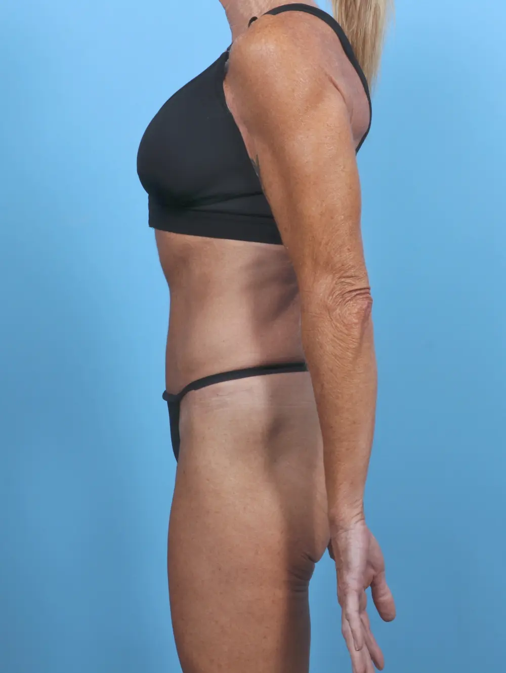 Tummy Tuck Patient Photo - Case 50520 - after view-2