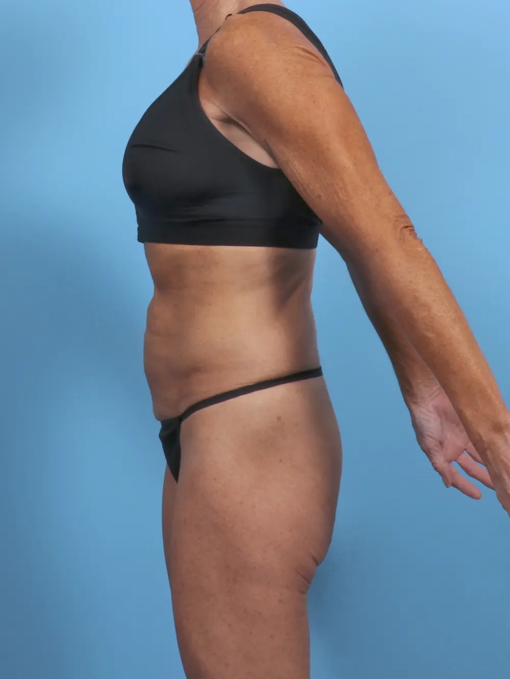 Tummy Tuck Patient Photo - Case 50520 - before view-2
