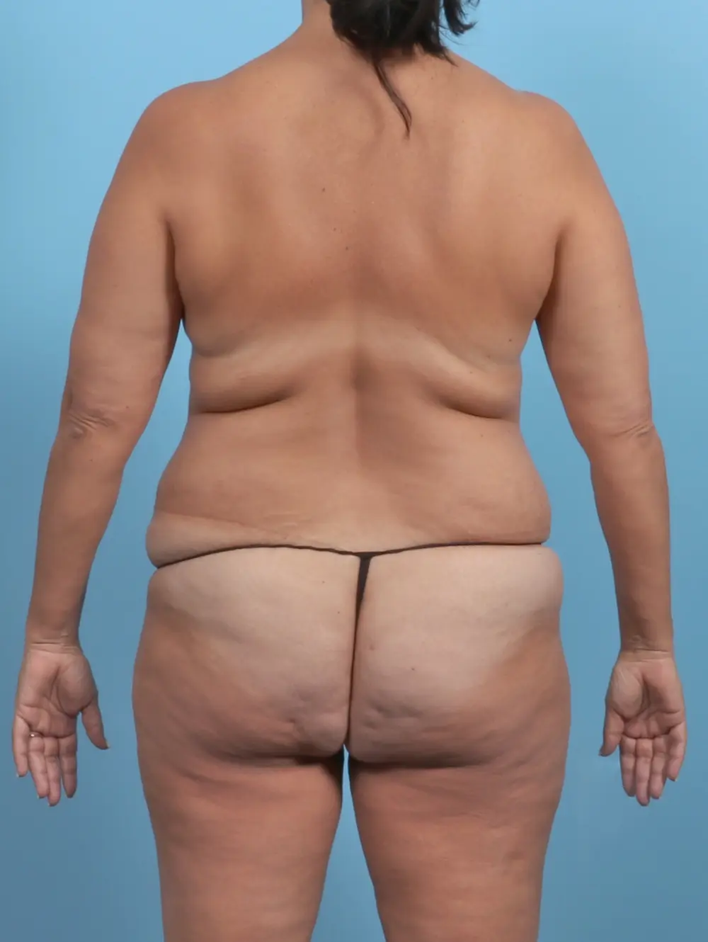 Breast Implant Removal Patient Photo - Case 50528 - before view-3