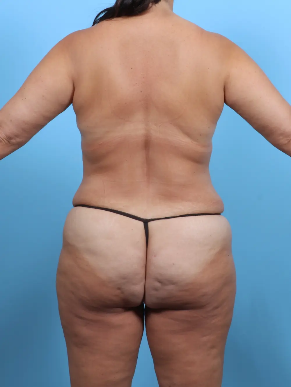 Breast Implant Removal Patient Photo - Case 50528 - after view-3