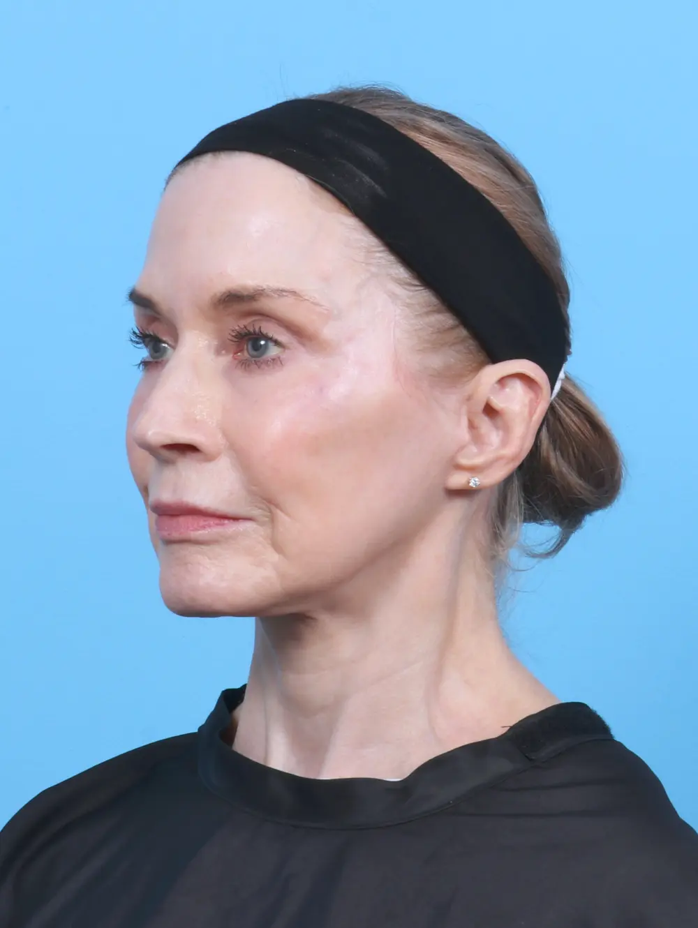 Eyelid Surgery Patient Photo - Case 50538 - after view-1