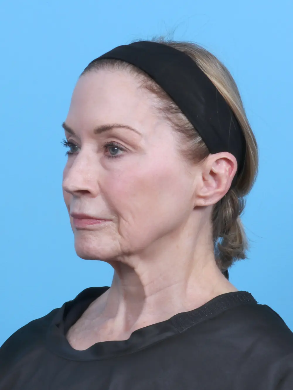 Eyelid Surgery Patient Photo - Case 50538 - before view-1