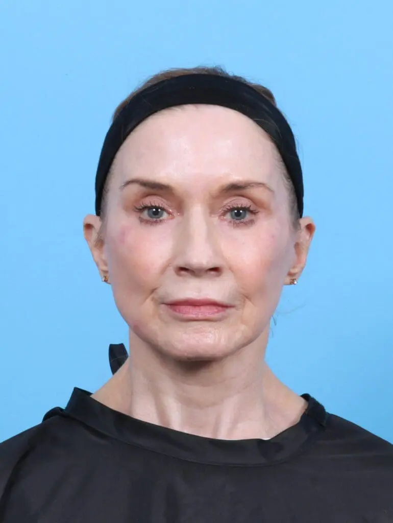 Eyelid Surgery - Case 50538 - After