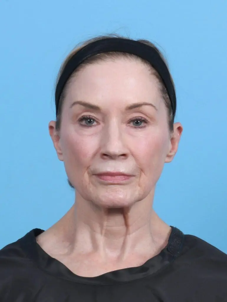 Eyelid Surgery - Case 50538 - Before