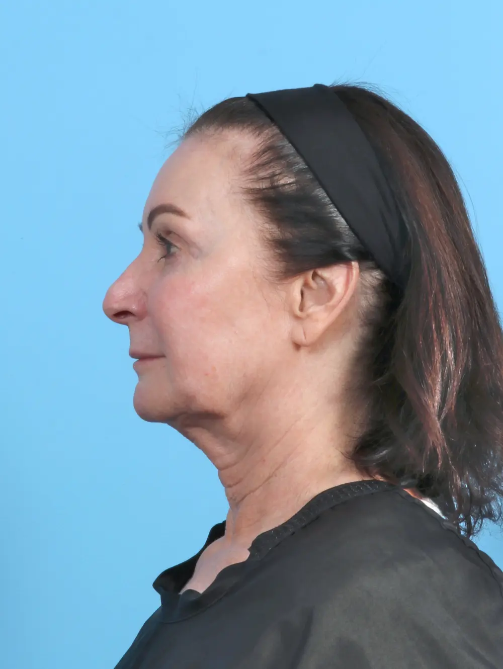 Facelift / Neck Lift Patient Photo - Case 50554 - before view-2
