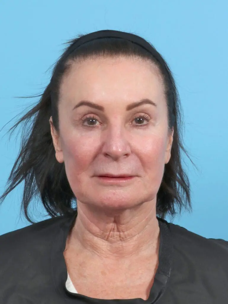 Facelift / Neck Lift - Case 50554 - Before