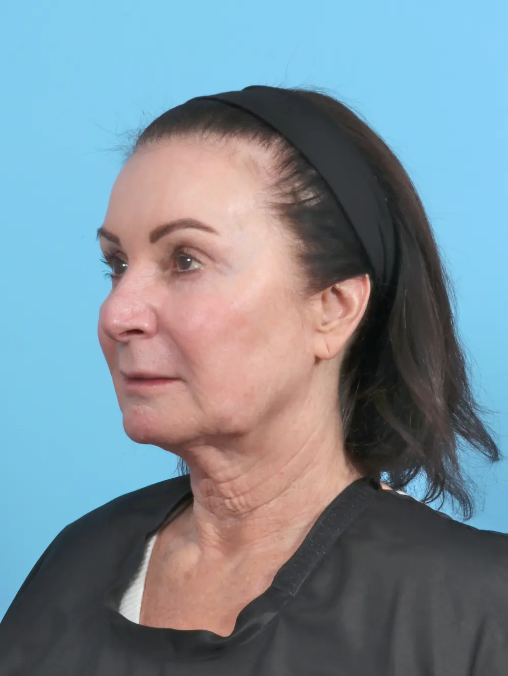 Facelift / Neck Lift Patient Photo - Case 50554 - before view-1