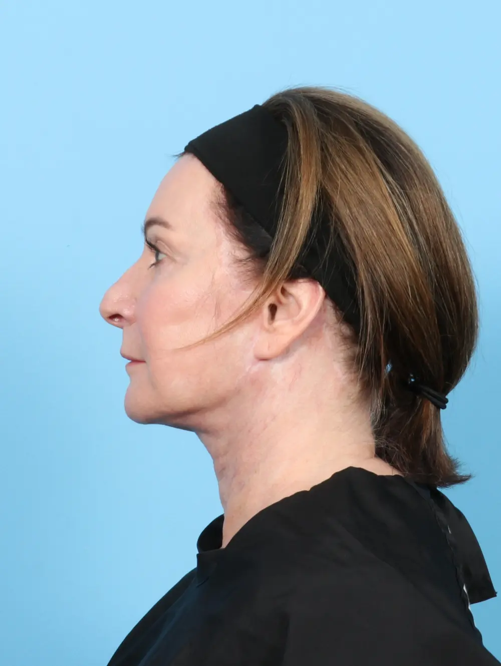 Facelift / Neck Lift Patient Photo - Case 50554 - after view-2