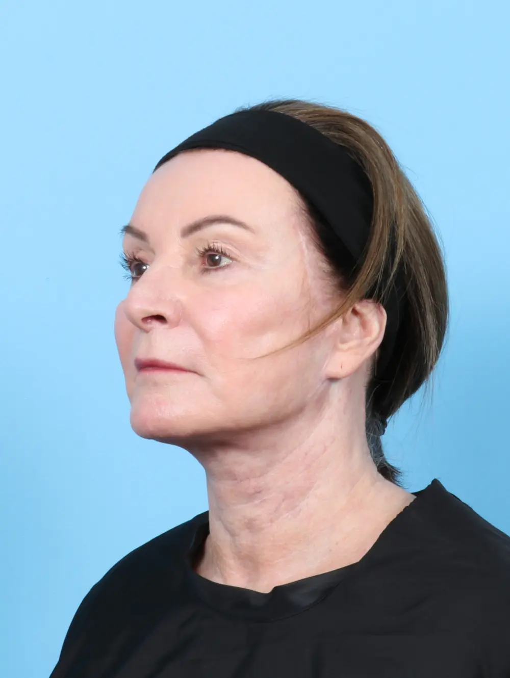 Facelift / Neck Lift Patient Photo - Case 50554 - after view-1