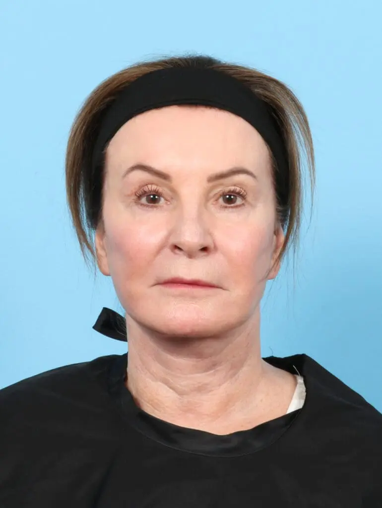 Facelift / Neck Lift - Case 50554 - After