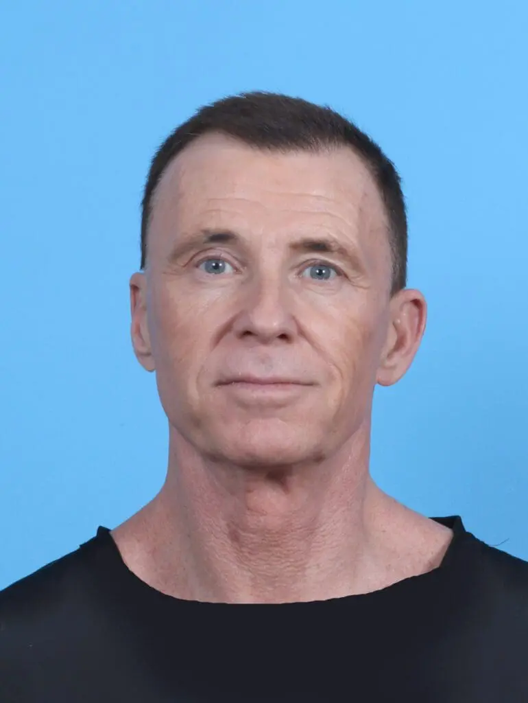 Facelift / Neck Lift - Case 50562 - Before