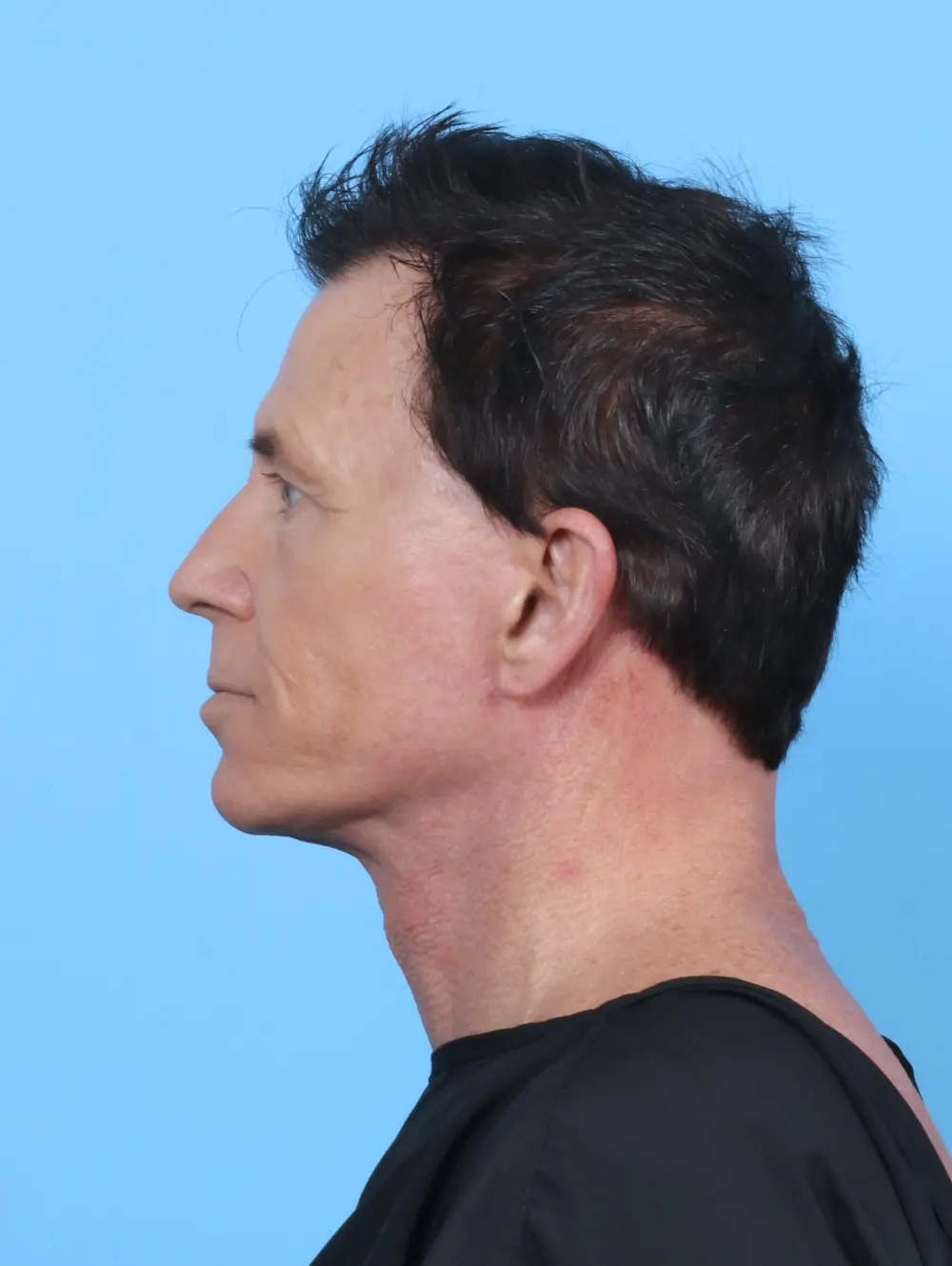 Facelift / Neck Lift Patient Photo - Case 50562 - after view-2