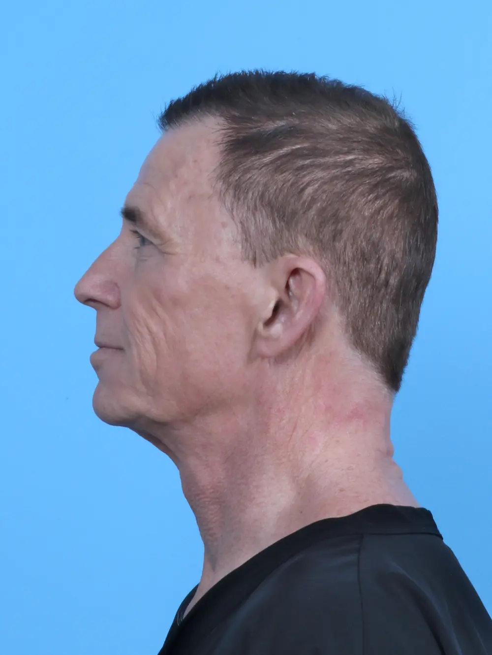 Facelift / Neck Lift Patient Photo - Case 50562 - before view-2