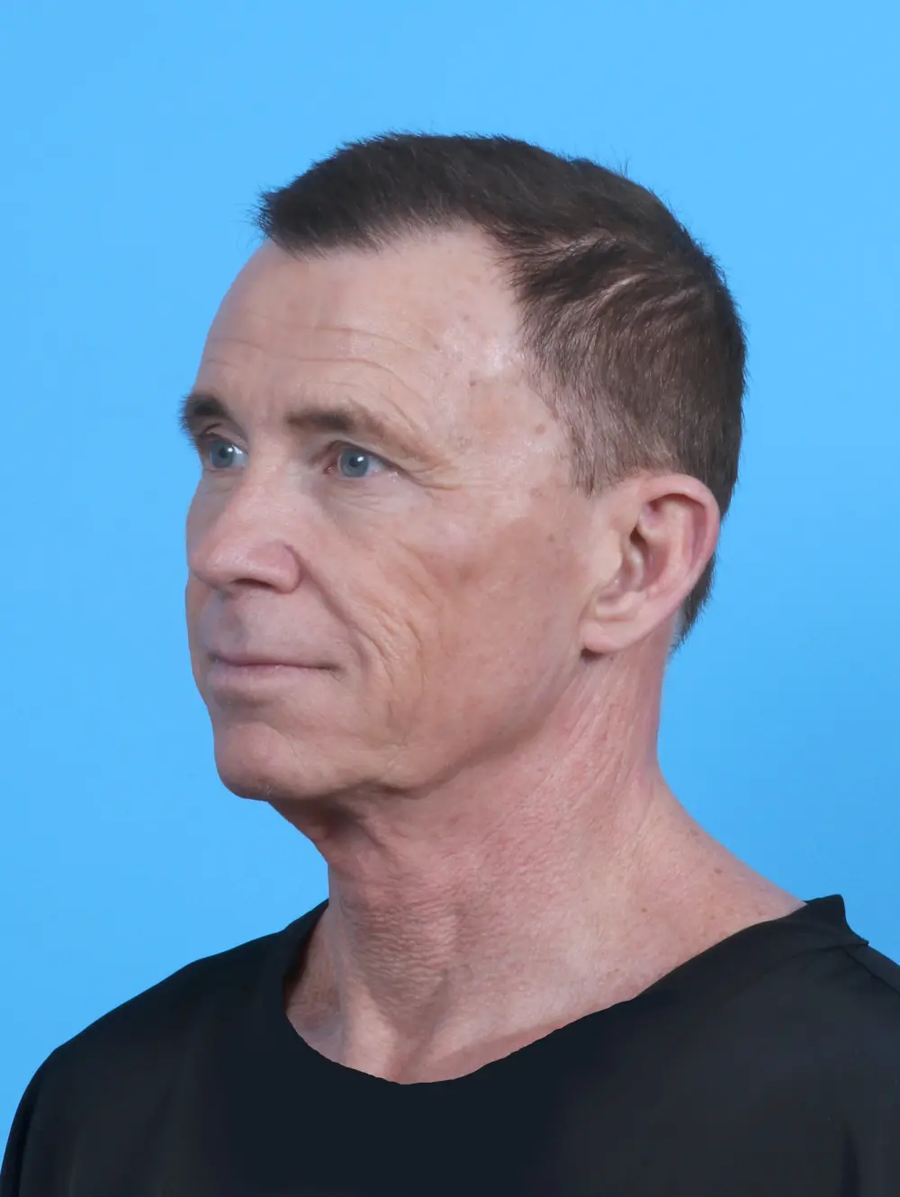 Facelift / Neck Lift Patient Photo - Case 50562 - before view-1