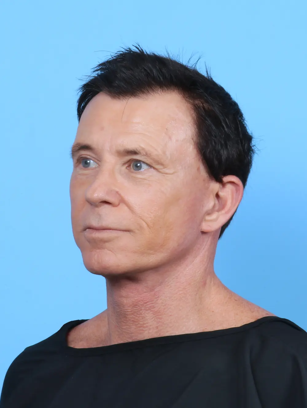 Facelift / Neck Lift Patient Photo - Case 50562 - after view-1