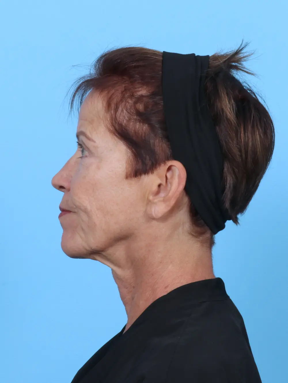 Eyelid Surgery Patient Photo - Case 50578 - after view-2