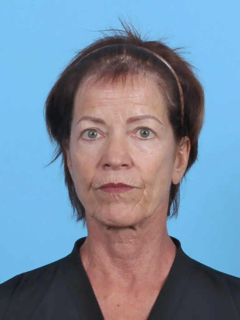 Eyelid Surgery - Case 50578 - Before