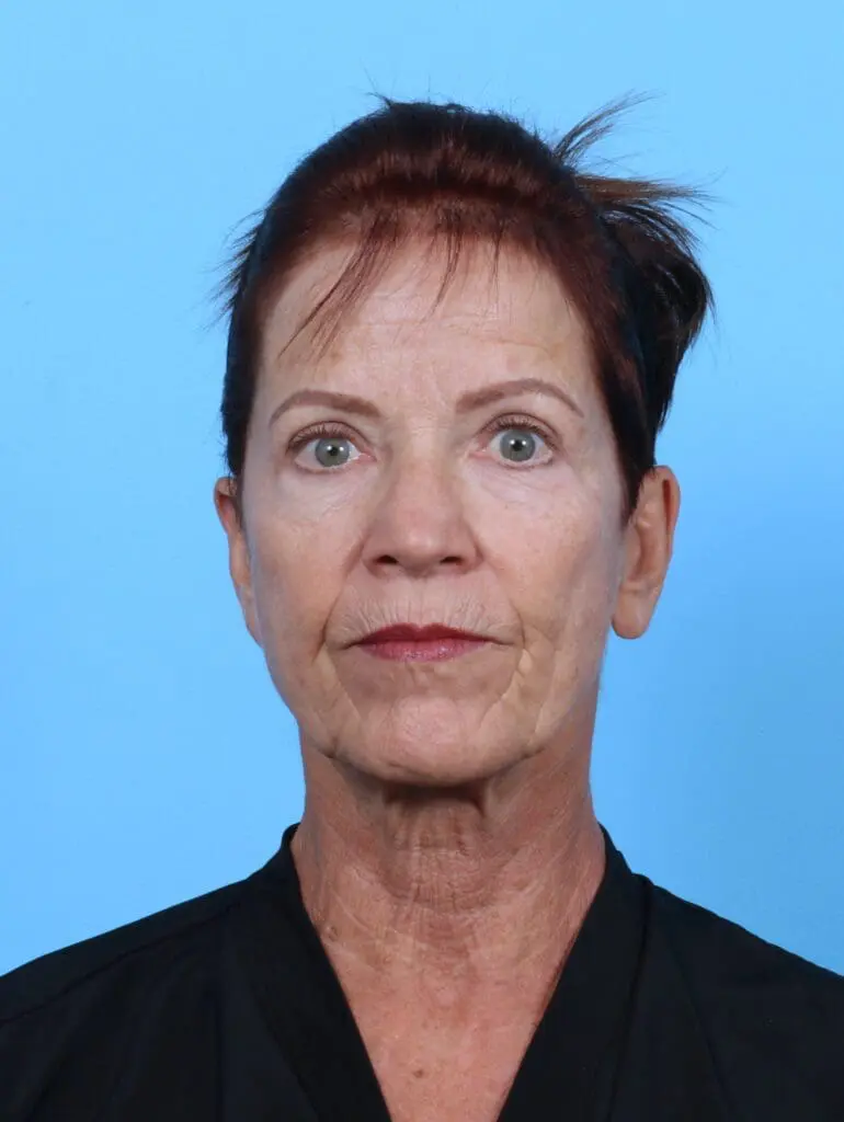 Eyelid Surgery - Case 50578 - After