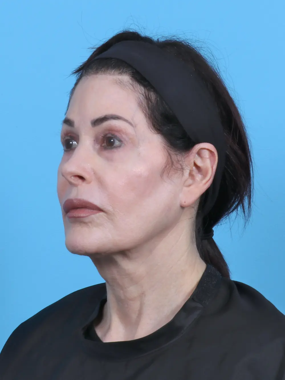 Eyelid Surgery Patient Photo - Case 50595 - before view-1