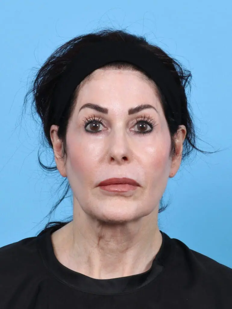 Eyelid Surgery - Case 50595 - After