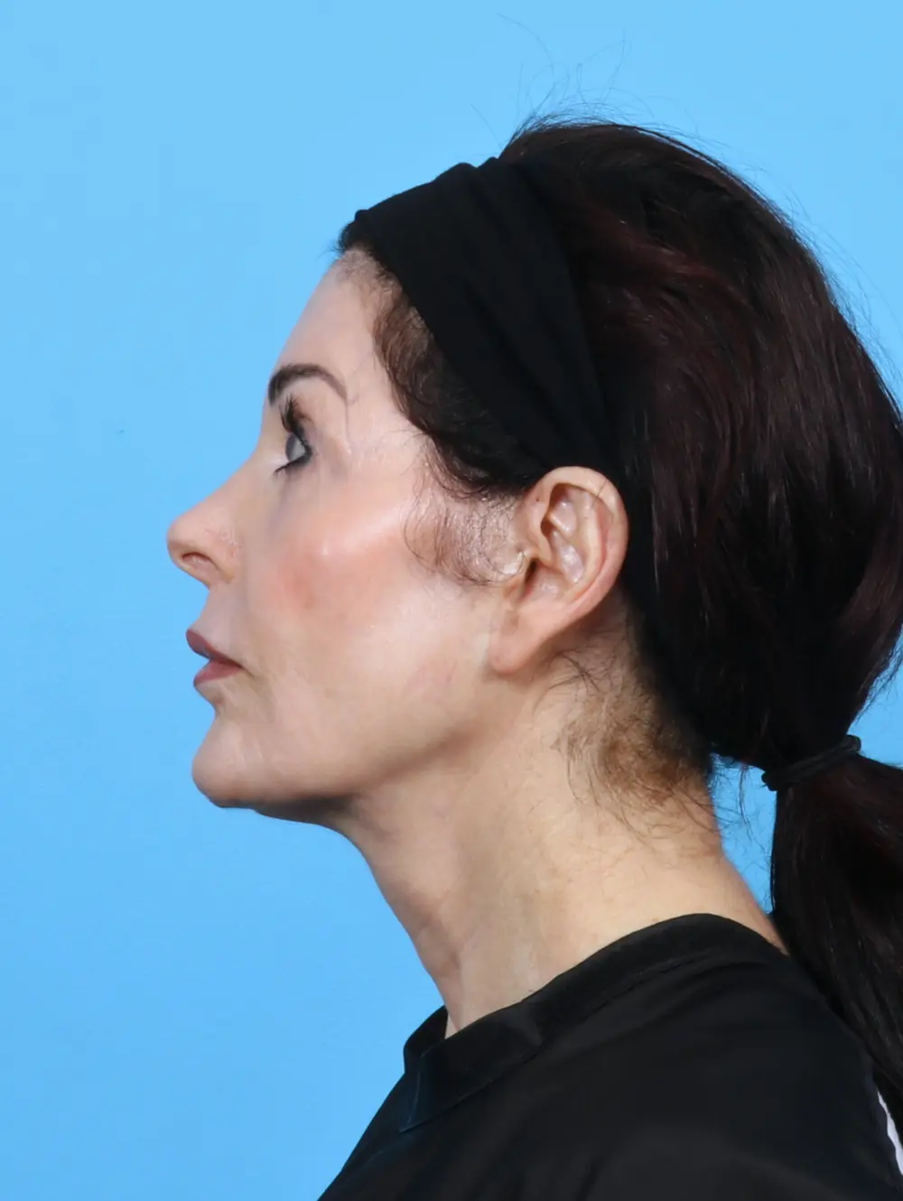 Eyelid Surgery Patient Photo - Case 50595 - after view-2