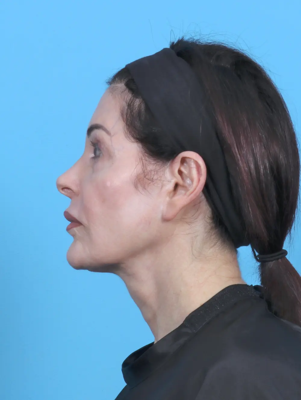 Eyelid Surgery Patient Photo - Case 50595 - before view-2