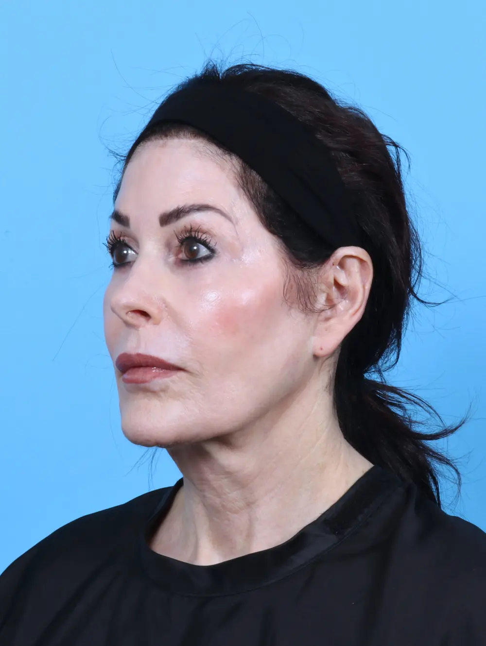 Eyelid Surgery Patient Photo - Case 50595 - after view-1