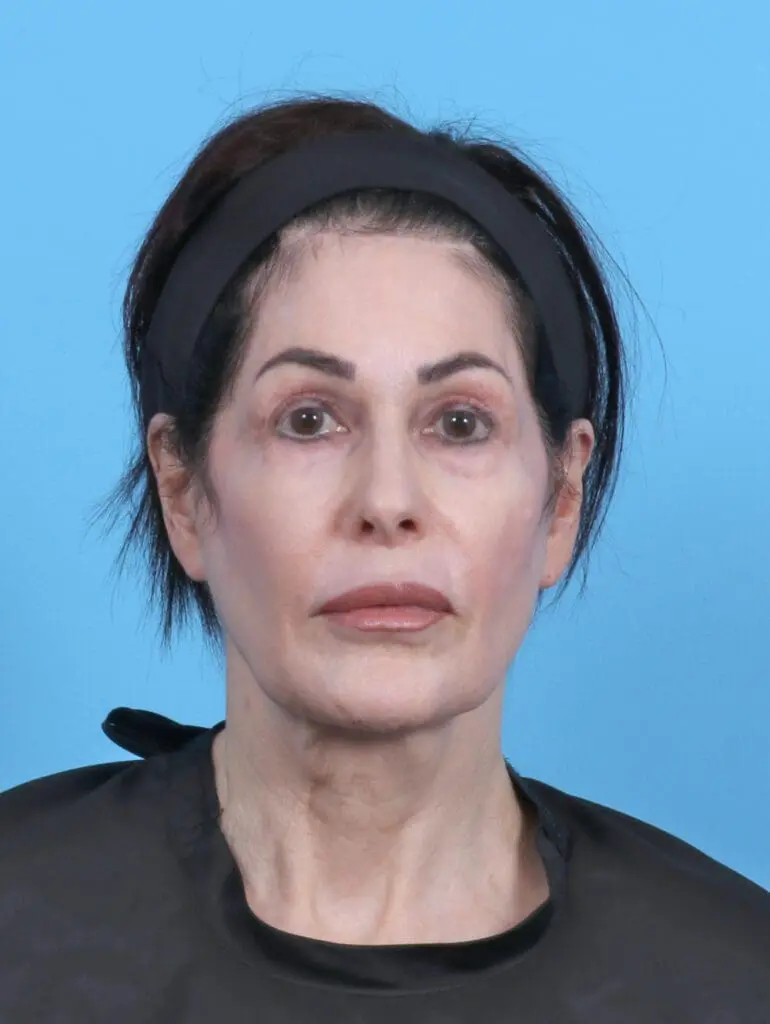 Eyelid Surgery - Case 50595 - Before