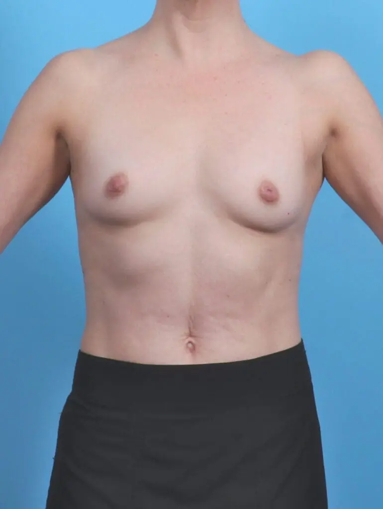 Breast Augmentation - Case 50603 - Before
