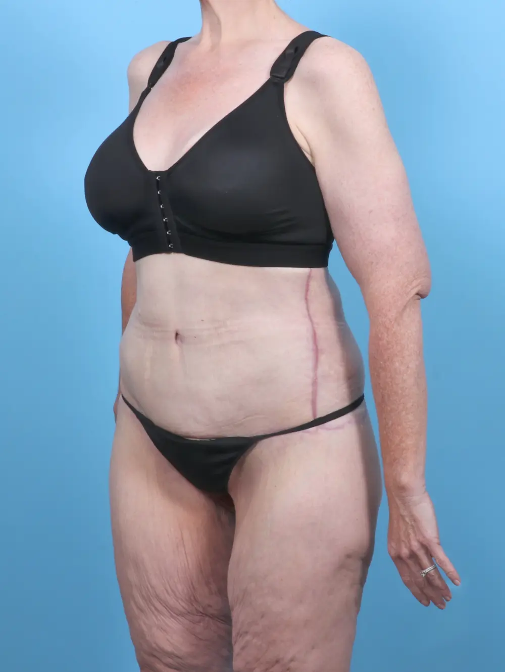 After Weight Loss Patient Photo - Case 50611 - after view-1