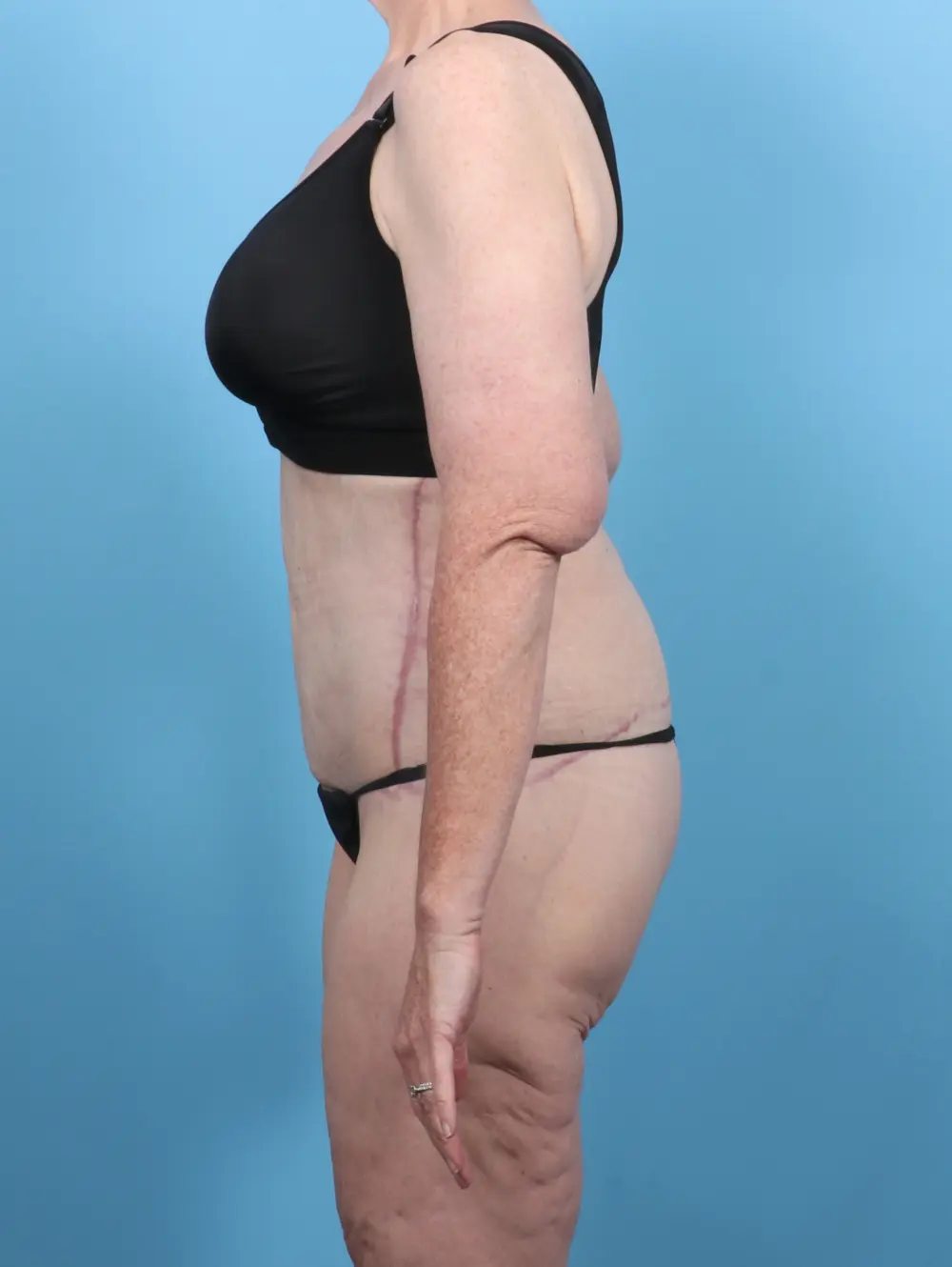 After Weight Loss Patient Photo - Case 50611 - after view-2