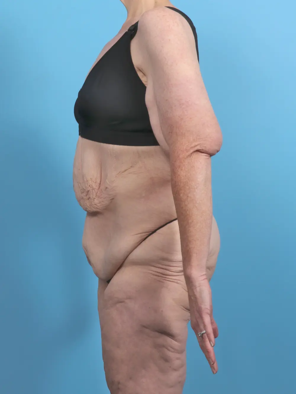 After Weight Loss Patient Photo - Case 50611 - before view-2