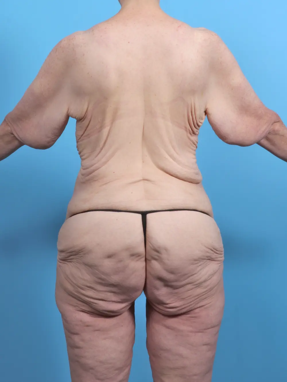After Weight Loss Patient Photo - Case 50611 - before view-3