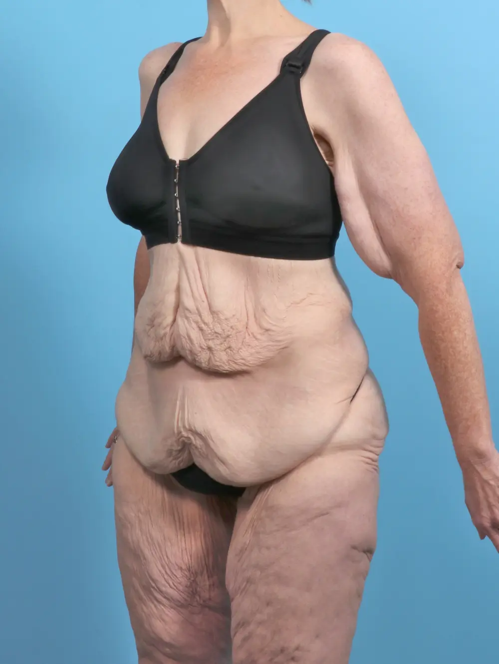 After Weight Loss Patient Photo - Case 50611 - before view-1