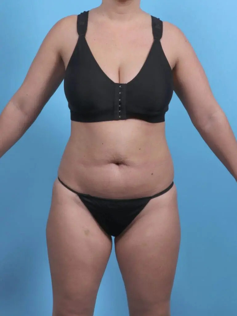 Tummy Tuck - Case 50646 - Before