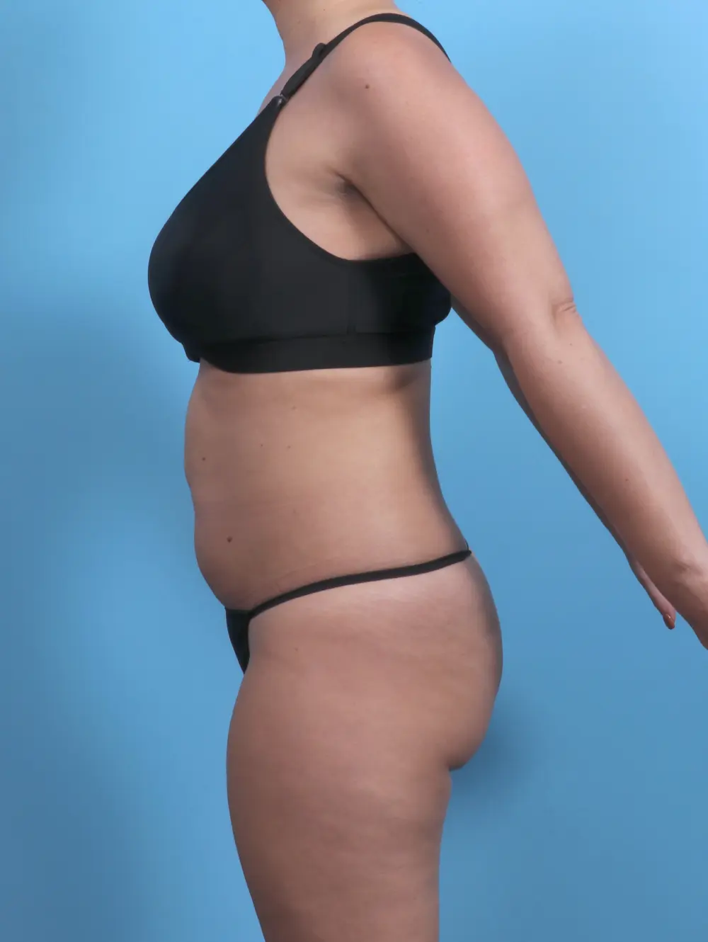 Tummy Tuck Patient Photo - Case 50646 - before view-2