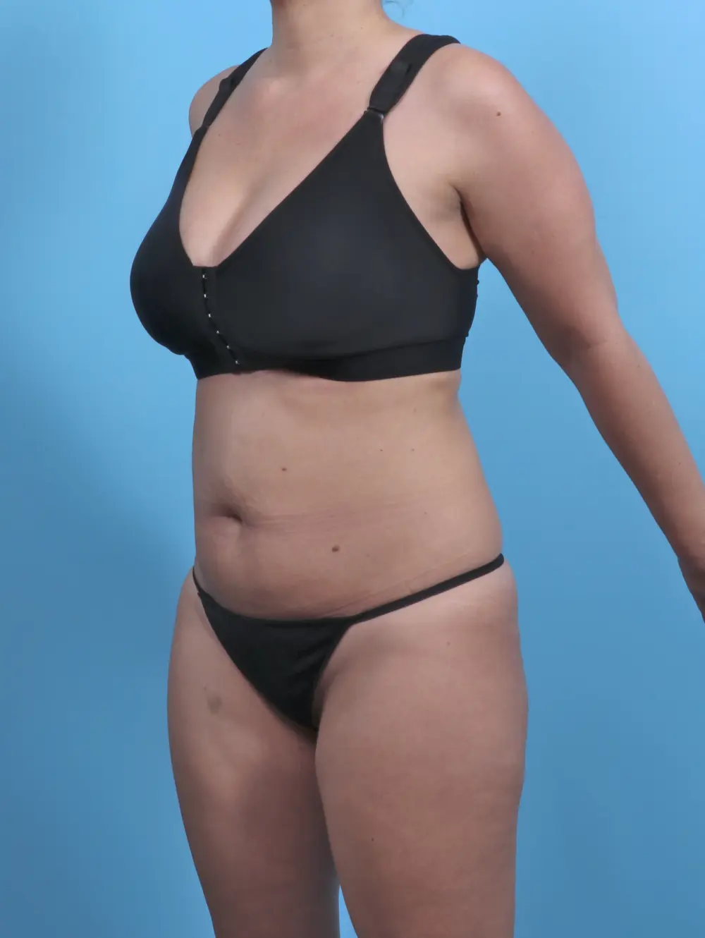 Tummy Tuck Patient Photo - Case 50646 - before view-1