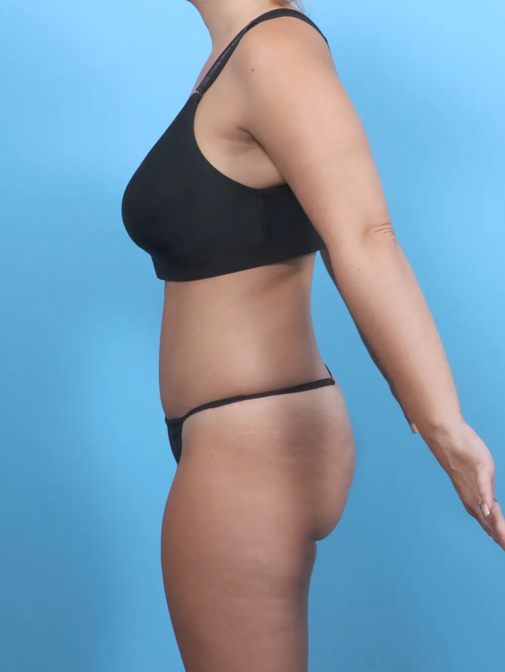 Tummy Tuck Patient Photo - Case 50646 - after view-2
