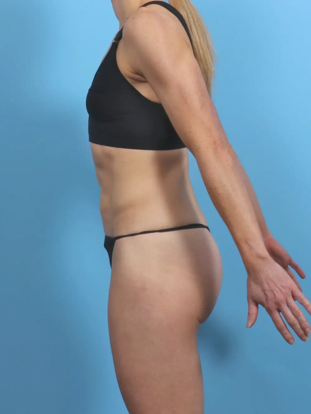 Tummy Tuck Patient Photo - Case 50662 - before view-2
