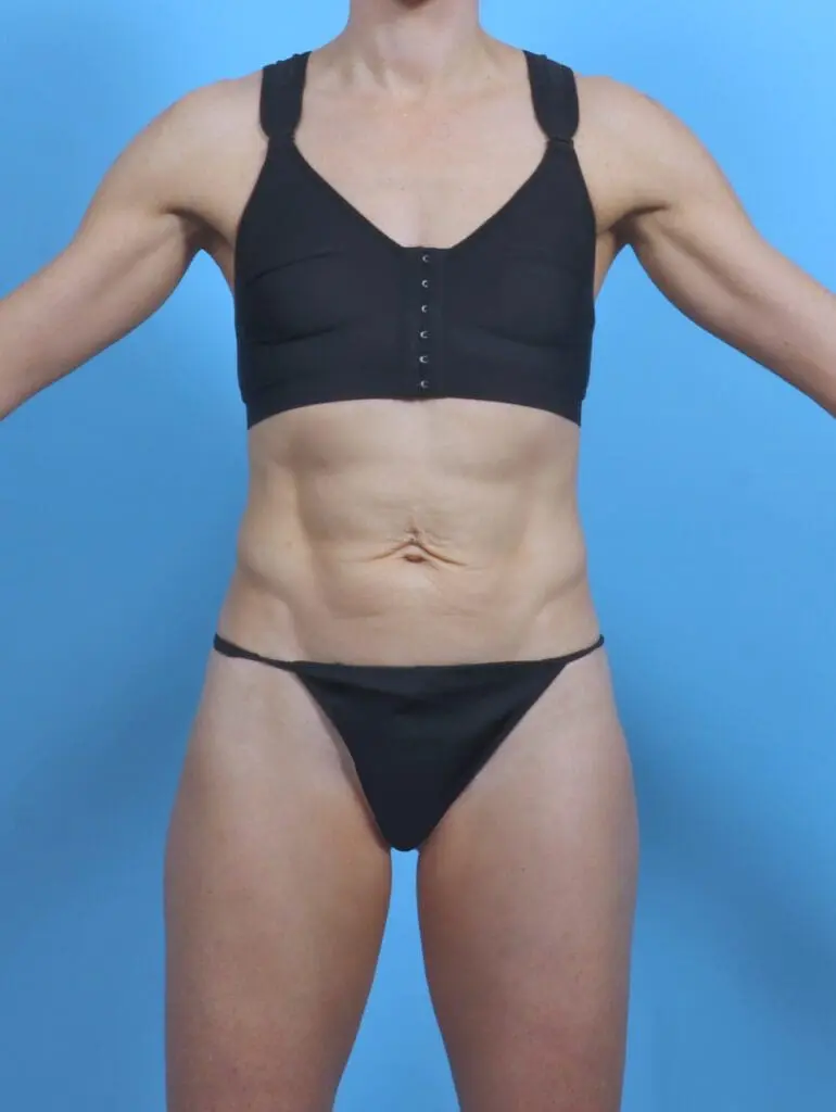 Tummy Tuck - Case 50662 - Before