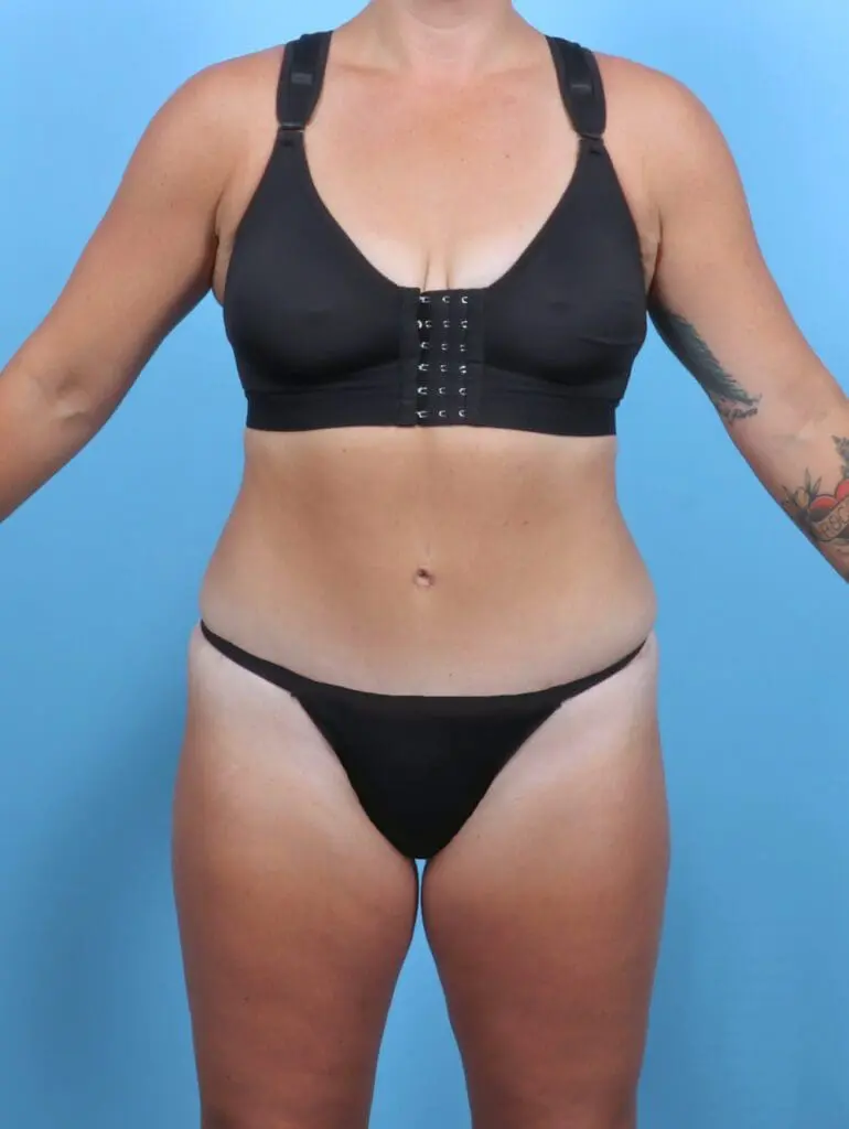 Tummy Tuck - Case 50812 - After