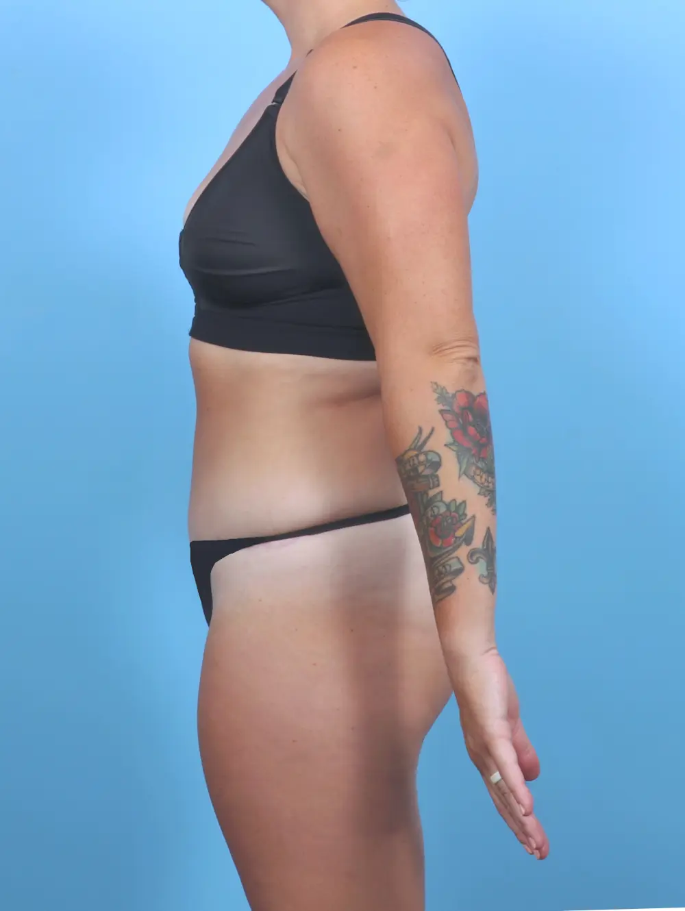 Tummy Tuck Patient Photo - Case 50812 - after view-2