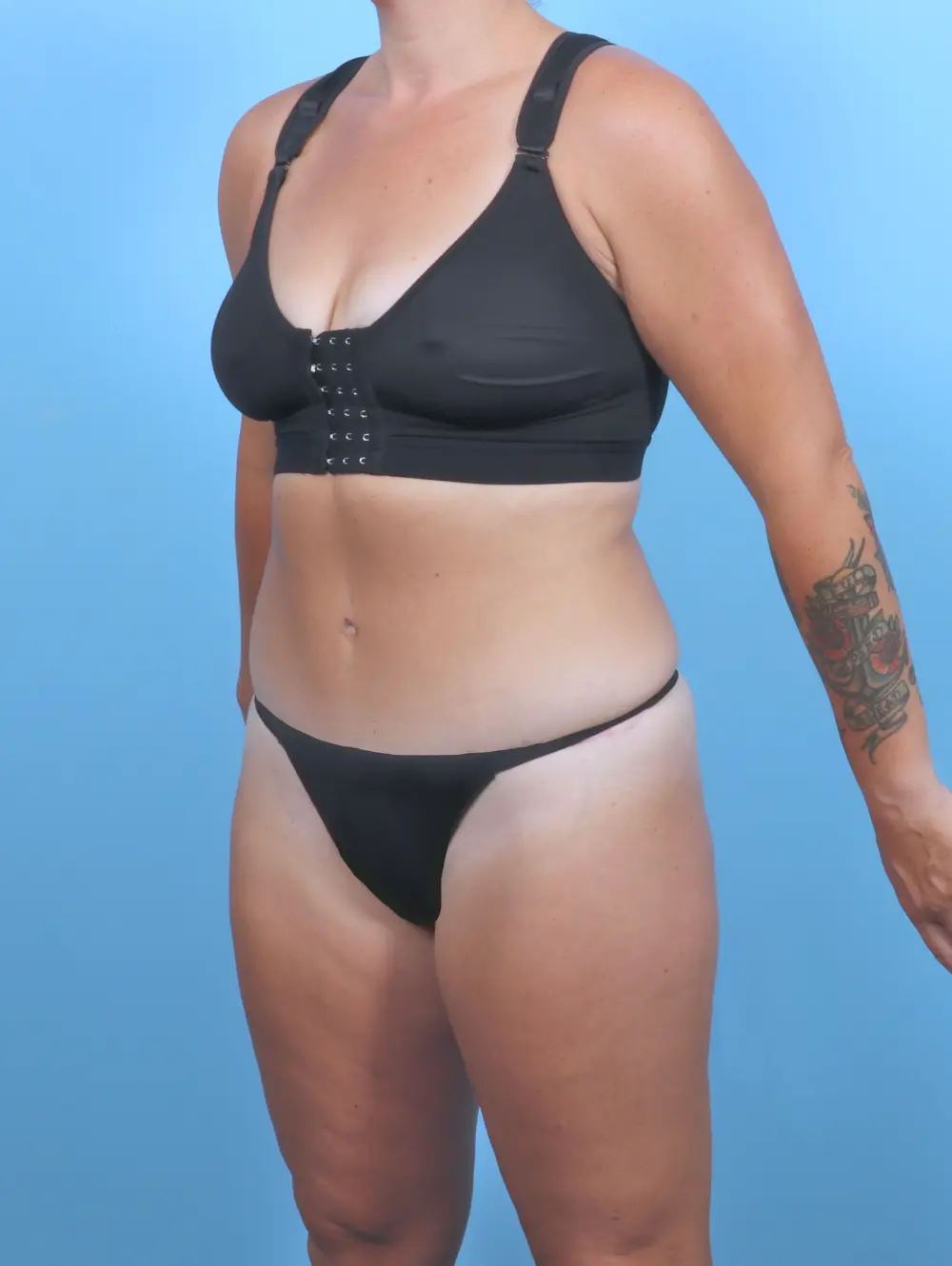 Tummy Tuck Patient Photo - Case 50812 - after view-1