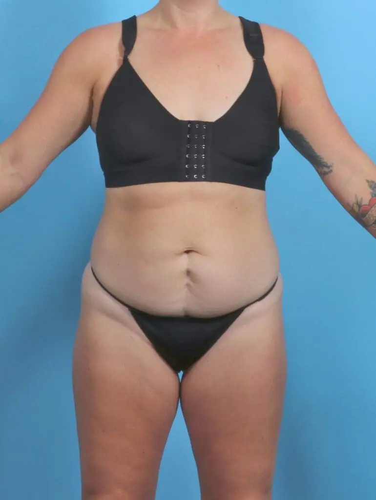 Tummy Tuck - Case 50812 - Before